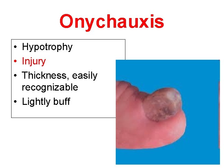 Onychauxis • Hypotrophy • Injury • Thickness, easily recognizable • Lightly buff 