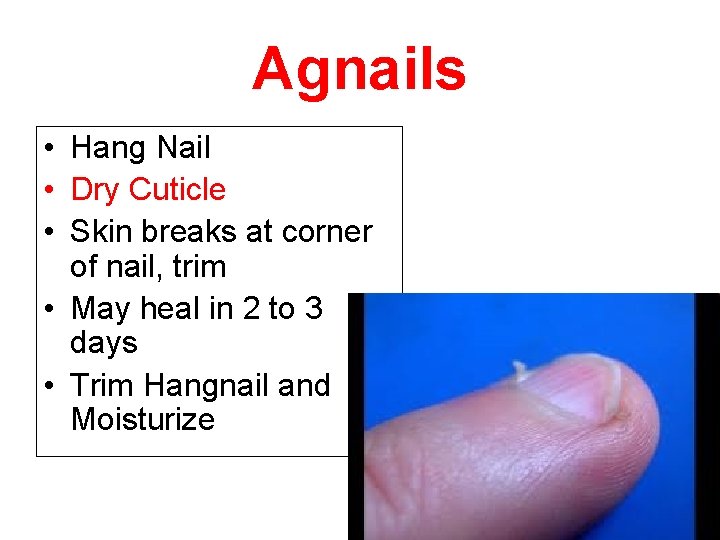 Agnails • Hang Nail • Dry Cuticle • Skin breaks at corner of nail,