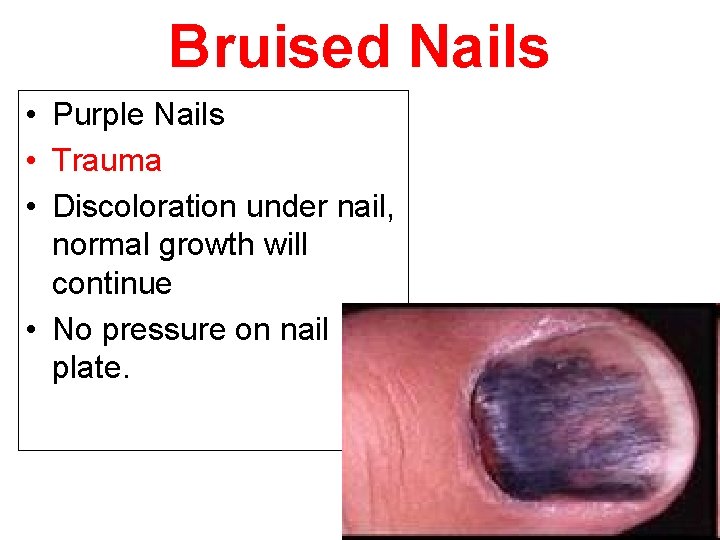 Bruised Nails • Purple Nails • Trauma • Discoloration under nail, normal growth will