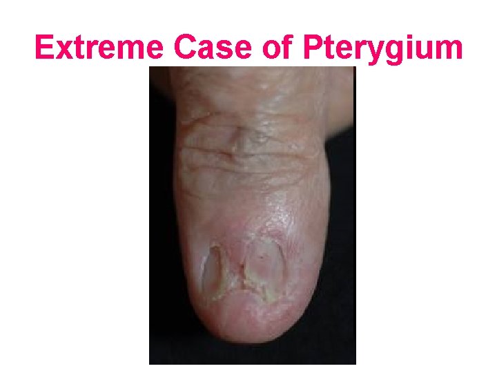 Extreme Case of Pterygium 