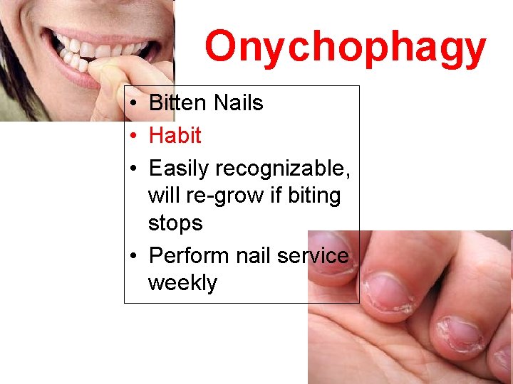 Onychophagy • Bitten Nails • Habit • Easily recognizable, will re-grow if biting stops