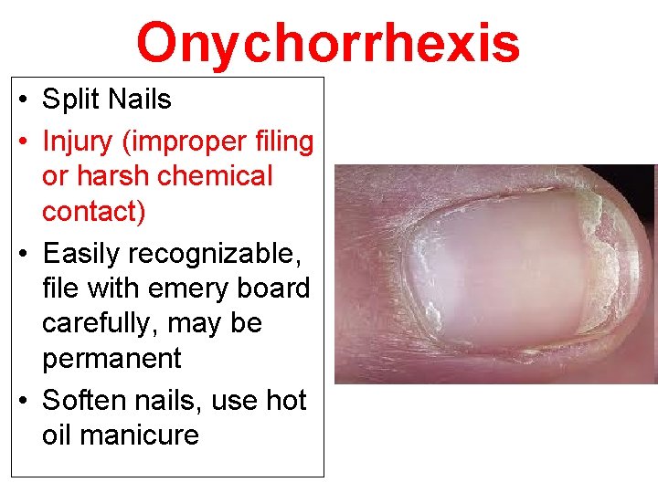 Onychorrhexis • Split Nails • Injury (improper filing or harsh chemical contact) • Easily