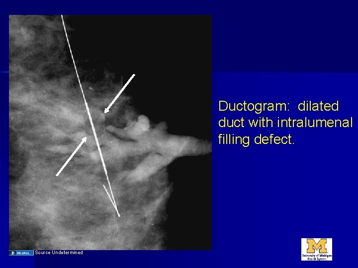 Ductogram: dilated duct with intralumenal filling defect. Source Undetermined 