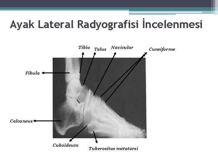 Ayak Lateral Radyografisi İncelenmesi Tibia Talus Navicular Fibula Calcaneus Cuboideum Tuberositas metatarsi Cuneiforme Ayak Lateral Radyografisi İncelenmesi Tibia Talus Navicular Fibula Calcaneus Cuboideum Tuberositas metatarsi Cuneiforme