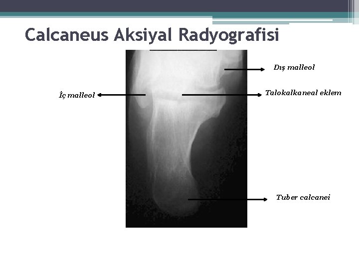 Calcaneus Aksiyal Radyografisi Dış malleol İç malleol Talokalkaneal eklem Tuber calcanei Calcaneus Aksiyal Radyografisi Dış malleol İç malleol Talokalkaneal eklem Tuber calcanei