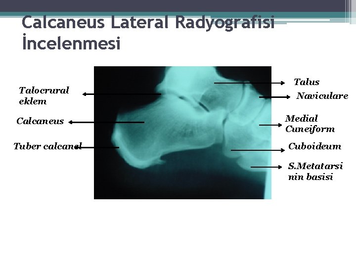 Calcaneus Lateral Radyografisi İncelenmesi Talocrural eklem Calcaneus Tuber calcanel Talus Naviculare Medial Cuneiform Cuboideum Calcaneus Lateral Radyografisi İncelenmesi Talocrural eklem Calcaneus Tuber calcanel Talus Naviculare Medial Cuneiform Cuboideum