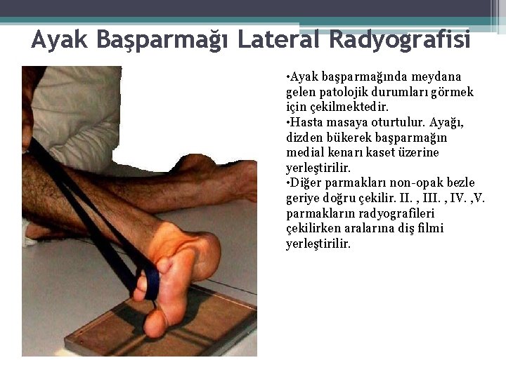 Ayak Başparmağı Lateral Radyografisi • Ayak başparmağında meydana gelen patolojik durumları görmek için çekilmektedir. Ayak Başparmağı Lateral Radyografisi • Ayak başparmağında meydana gelen patolojik durumları görmek için çekilmektedir.