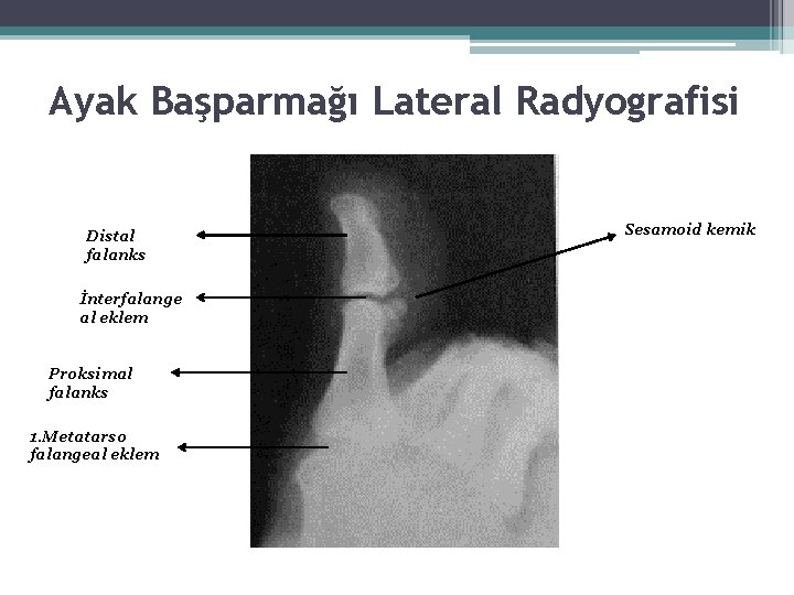 Ayak Başparmağı Lateral Radyografisi Distal falanks İnterfalange al eklem Proksimal falanks 1. Metatarso falangeal Ayak Başparmağı Lateral Radyografisi Distal falanks İnterfalange al eklem Proksimal falanks 1. Metatarso falangeal