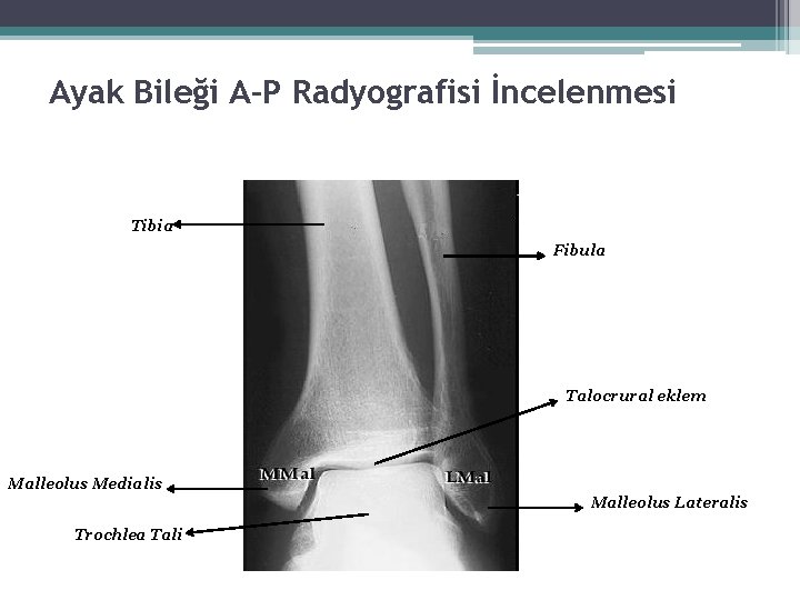 Ayak Bileği A-P Radyografisi İncelenmesi Tibia Fibula Talocrural eklem Malleolus Medialis Malleolus Lateralis Trochlea Ayak Bileği A-P Radyografisi İncelenmesi Tibia Fibula Talocrural eklem Malleolus Medialis Malleolus Lateralis Trochlea