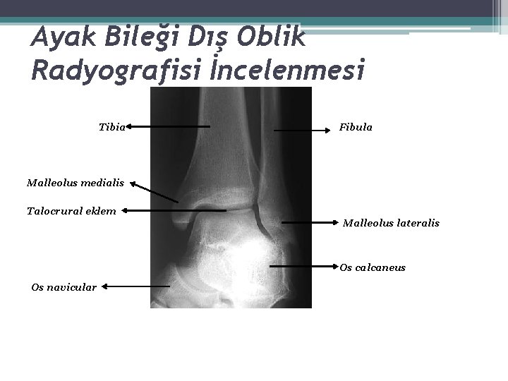 Ayak Bileği Dış Oblik Radyografisi İncelenmesi Tibia Fibula Malleolus medialis Talocrural eklem Malleolus lateralis Ayak Bileği Dış Oblik Radyografisi İncelenmesi Tibia Fibula Malleolus medialis Talocrural eklem Malleolus lateralis