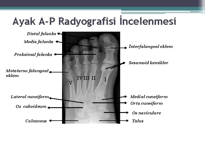 Ayak A-P Radyografisi İncelenmesi Distal falanks Media falanks İnterfalangeal eklem Proksimal falanks Sesamoid kemikler Ayak A-P Radyografisi İncelenmesi Distal falanks Media falanks İnterfalangeal eklem Proksimal falanks Sesamoid kemikler
