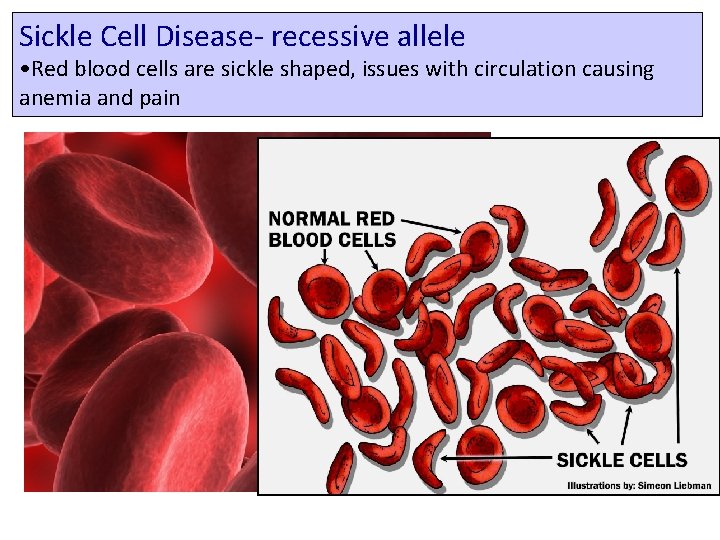 Sickle Cell Disease recessive allele • Red blood cells are sickle shaped, issues with
