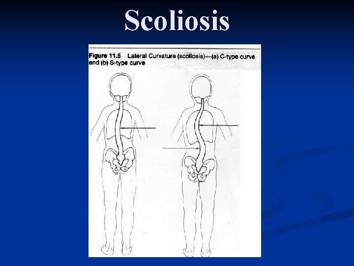 Scoliosis 