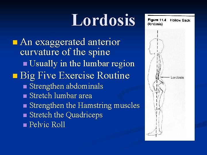 Lordosis n An exaggerated anterior curvature of the spine n Usually in the lumbar