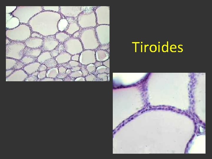 Tiroides 
