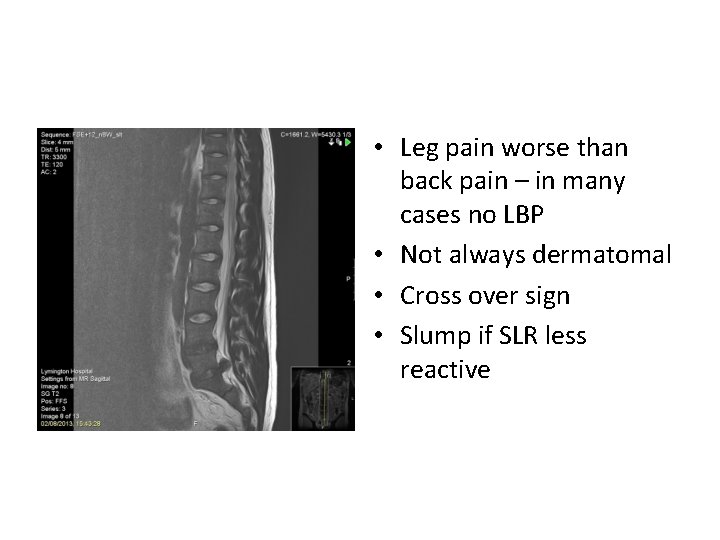 • Leg pain worse than back pain – in many cases no LBP • Leg pain worse than back pain – in many cases no LBP