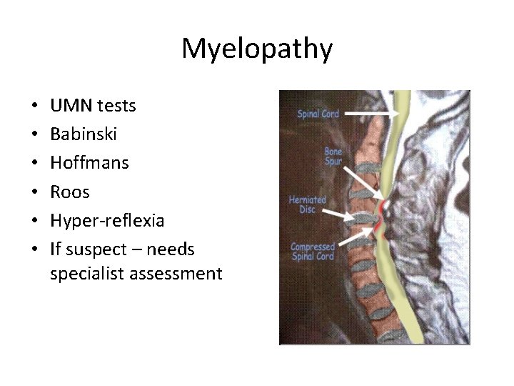 Myelopathy • • • UMN tests Babinski Hoffmans Roos Hyper-reflexia If suspect – needs Myelopathy • • • UMN tests Babinski Hoffmans Roos Hyper-reflexia If suspect – needs