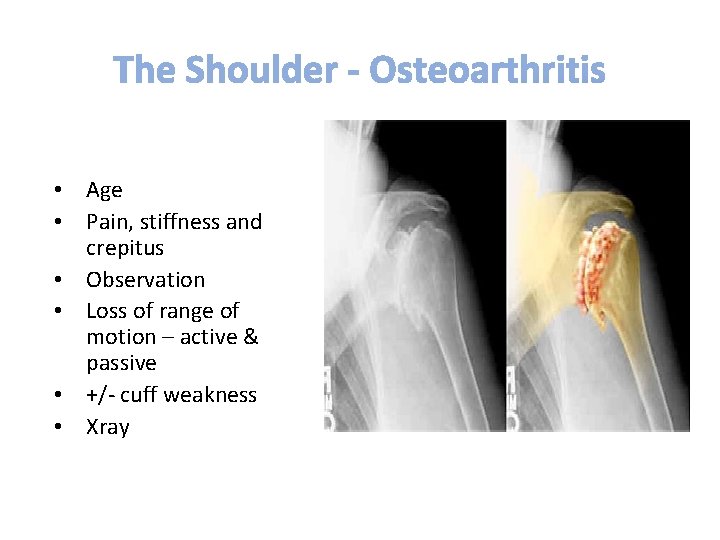 • Age • Pain, stiffness and crepitus • Observation • Loss of range • Age • Pain, stiffness and crepitus • Observation • Loss of range