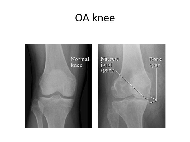 OA knee OA knee