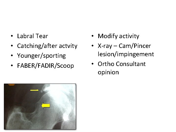 • • Labral Tear Catching/after actvity Younger/sporting FABER/FADIR/Scoop • Modify activity • X-ray • • Labral Tear Catching/after actvity Younger/sporting FABER/FADIR/Scoop • Modify activity • X-ray