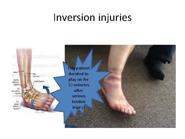 Inversion injuries This patient decided to play on for 30 minutes after serious tendon Inversion injuries This patient decided to play on for 30 minutes after serious tendon