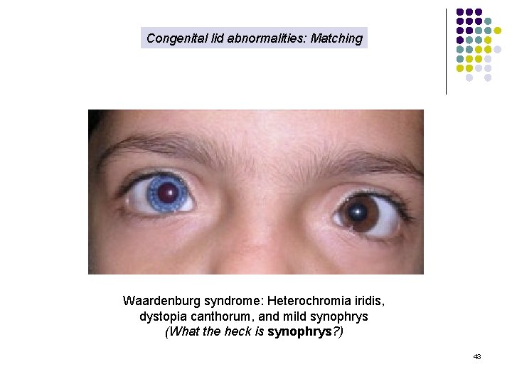 Congenital lid abnormalities: Matching Waardenburg syndrome: Heterochromia iridis, dystopia canthorum, and mild synophrys (What