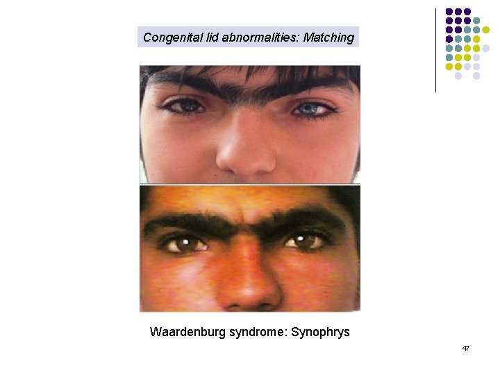 Congenital lid abnormalities: Matching Waardenburg syndrome: Synophrys 47 