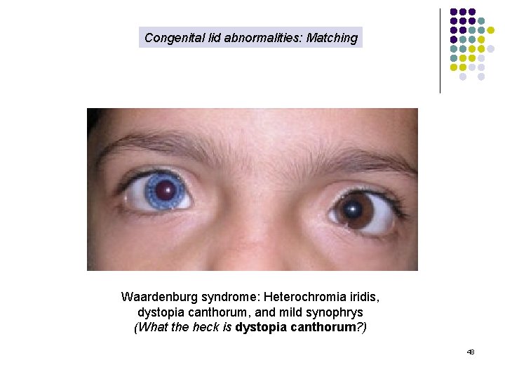 Congenital lid abnormalities: Matching Waardenburg syndrome: Heterochromia iridis, dystopia canthorum, and mild synophrys (What