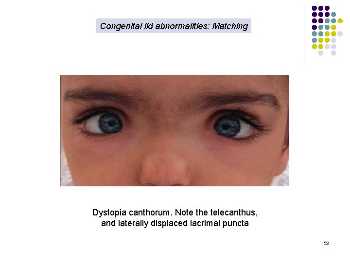 Congenital lid abnormalities: Matching Dystopia canthorum. Note the telecanthus, and laterally displaced lacrimal puncta