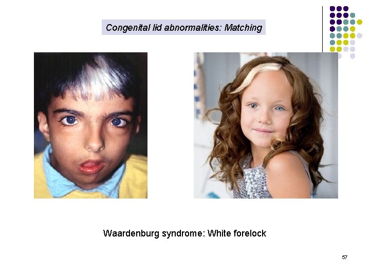 Congenital lid abnormalities: Matching Waardenburg syndrome: White forelock 57 