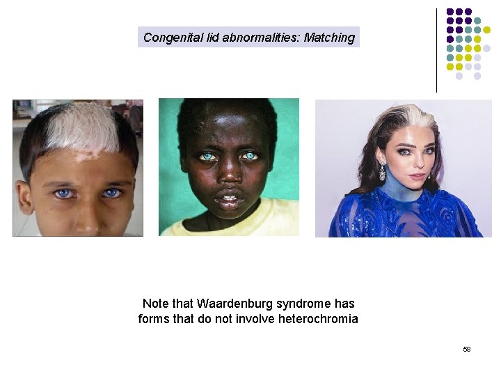 Congenital lid abnormalities: Matching Note that Waardenburg syndrome has forms that do not involve