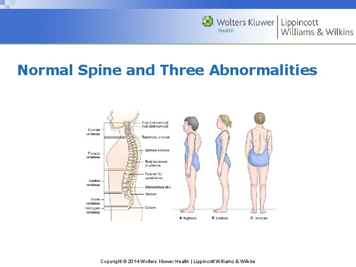 Normal Spine and Three Abnormalities Copyright © 2014 Wolters Kluwer Health | Lippincott Williams