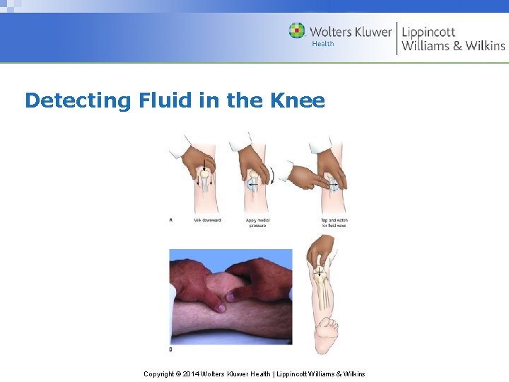 Detecting Fluid in the Knee Copyright © 2014 Wolters Kluwer Health | Lippincott Williams