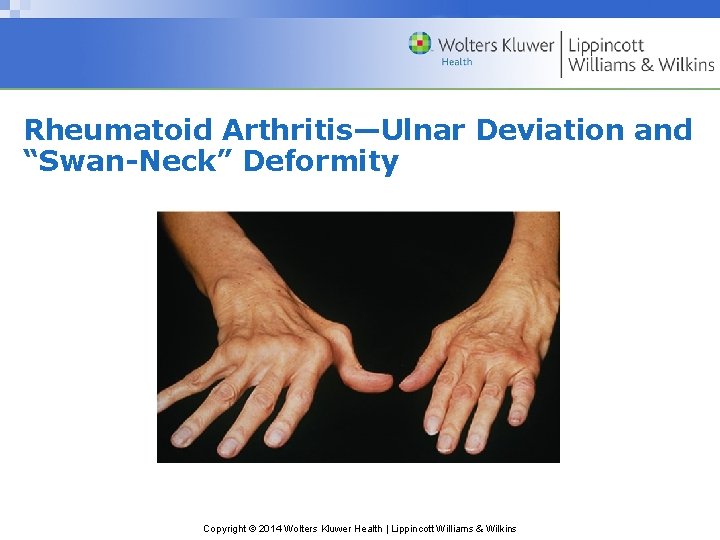 Rheumatoid Arthritis—Ulnar Deviation and “Swan-Neck” Deformity Copyright © 2014 Wolters Kluwer Health | Lippincott