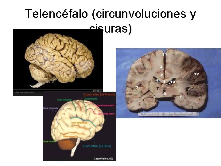 Telencéfalo (circunvoluciones y cisuras) 