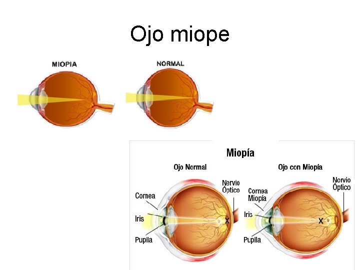 Ojo miope 