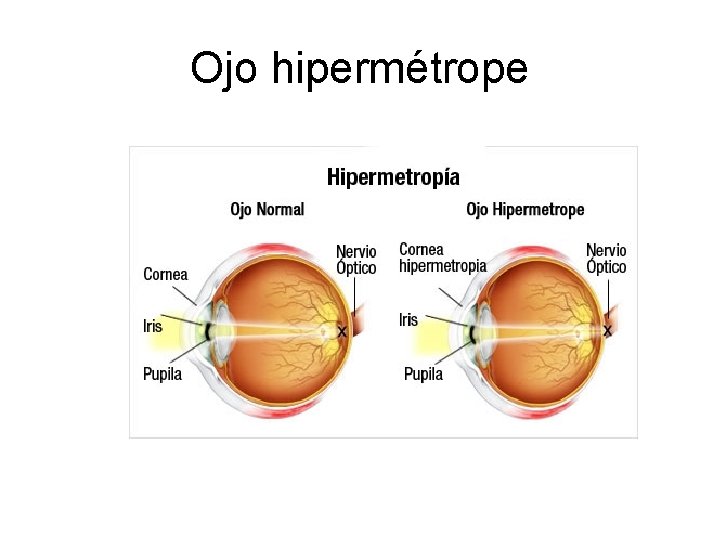 Ojo hipermétrope 