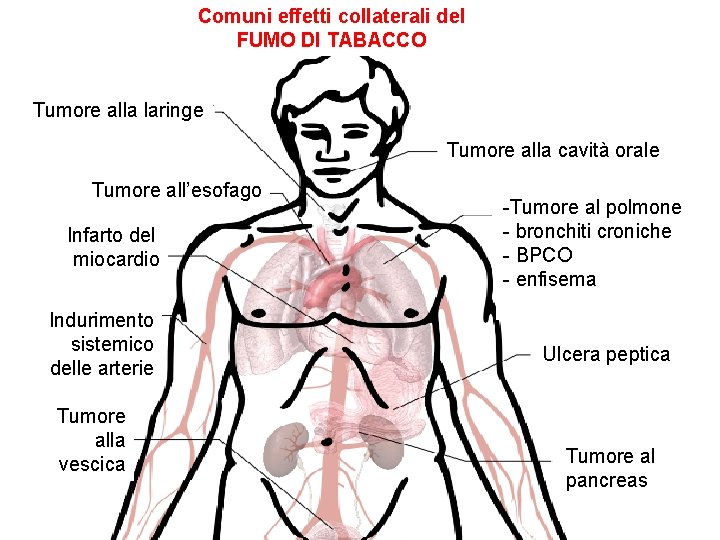 Comuni effetti collaterali del FUMO DI TABACCO Tumore alla laringe Tumore alla cavità orale