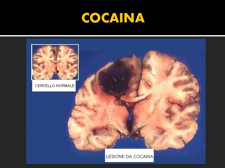 COCAINA CERVELLO NORMALE LESIONE DA COCAINA 