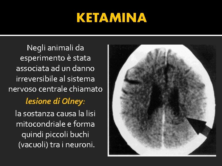 KETAMINA Negli animali da esperimento è stata associata ad un danno irreversibile al sistema