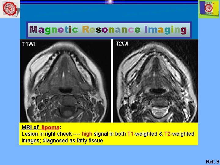 Magnetic Resonance Imaging T 1 WI T 2 WI MRI of lipoma: Lesion in