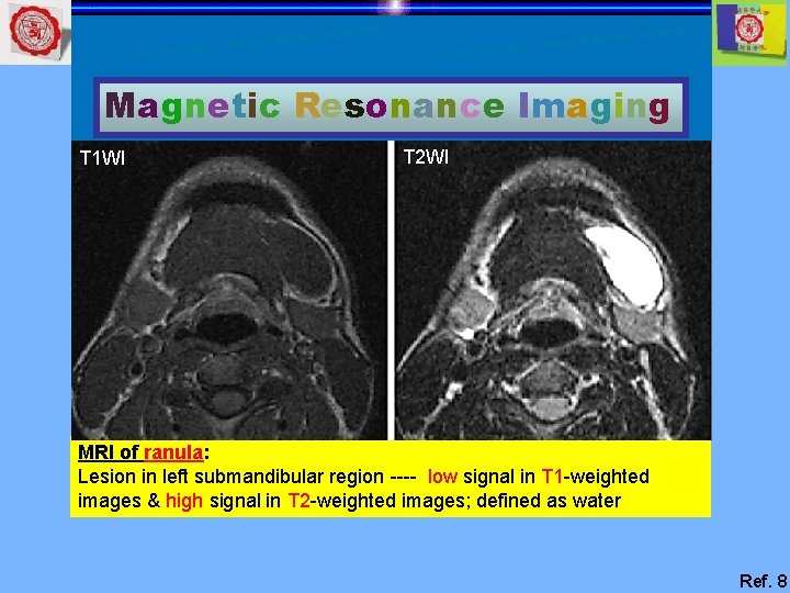 Magnetic Resonance Imaging T 1 WI T 2 WI MRI of ranula: Lesion in