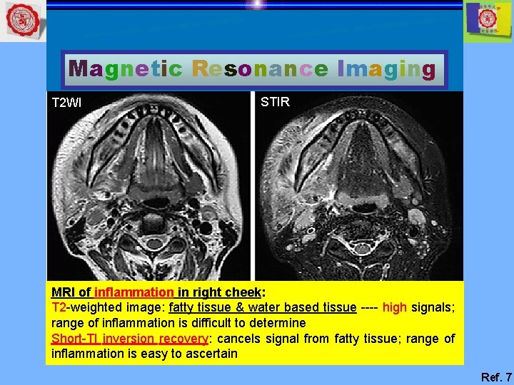 Magnetic Resonance Imaging T 2 WI STIR MRI of inflammation in right cheek: T