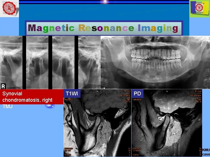 Magnetic Resonance Imaging Synovial chondromatosis, right TMJ T 1 WI PD KMU case 