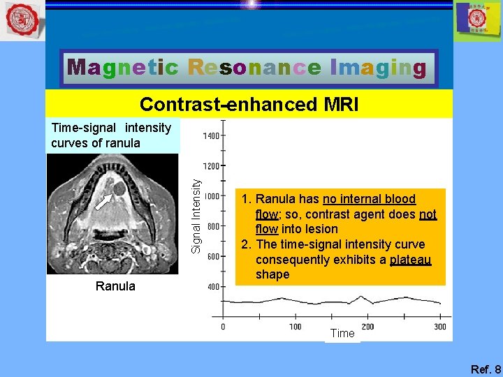 Magnetic Resonance Imaging Contrast-enhanced MRI Signal Intensity Time-signal intensity curves of ranula Ranula 1.