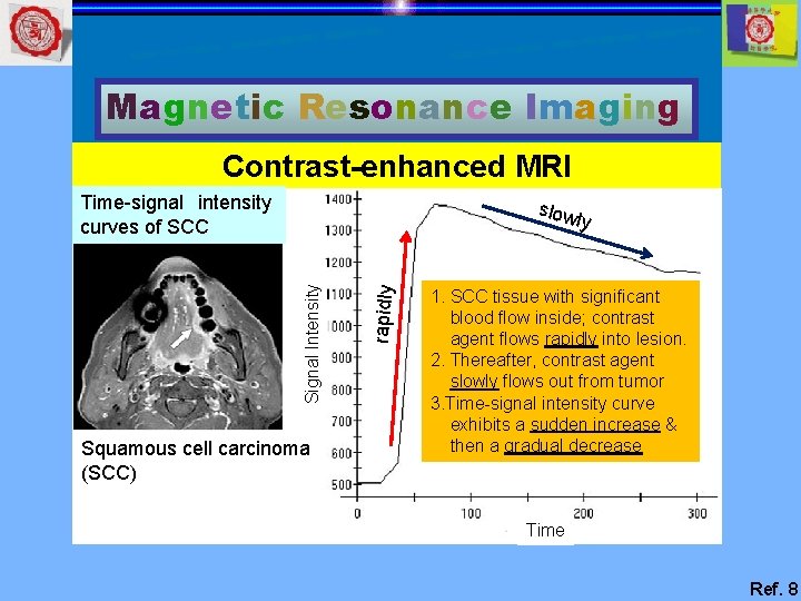 Magnetic Resonance Imaging Contrast-enhanced MRI Time-signal intensity curves of SCC slow Squamous cell carcinoma