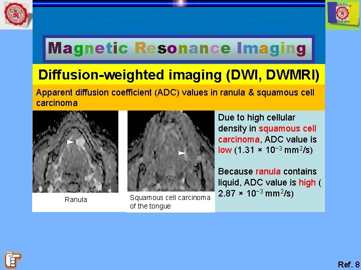 Magnetic Resonance Imaging Diffusion-weighted imaging (DWI, DWMRI) Apparent diffusion coefficient (ADC) values in ranula