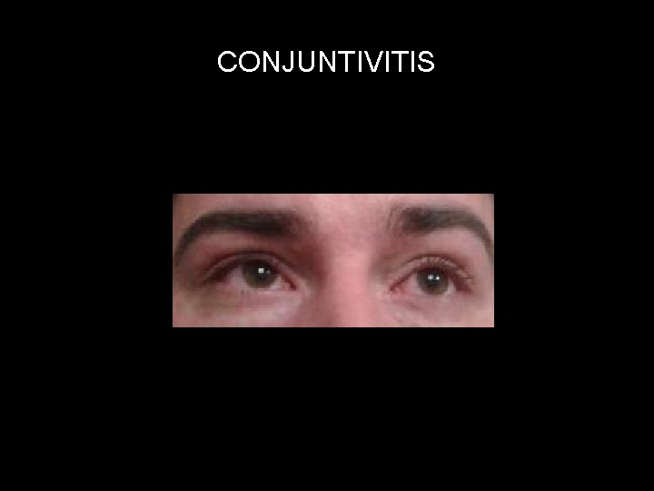 CONJUNTIVITIS 