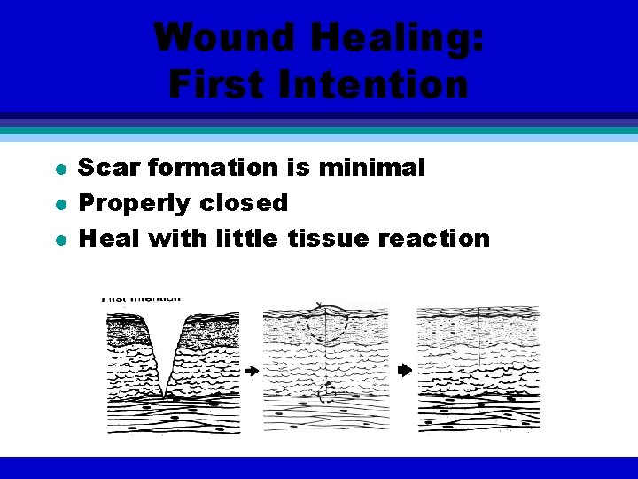 Wound Healing: First Intention l l l Scar formation is minimal Properly closed Heal