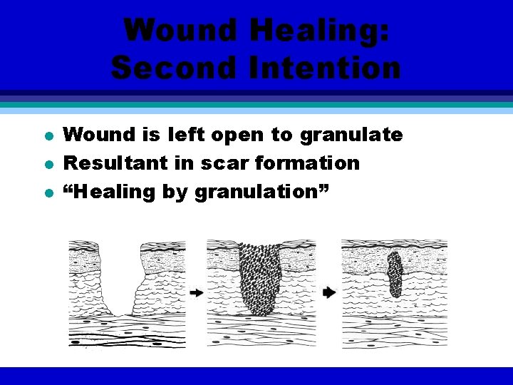 Wound Healing: Second Intention l l l Wound is left open to granulate Resultant